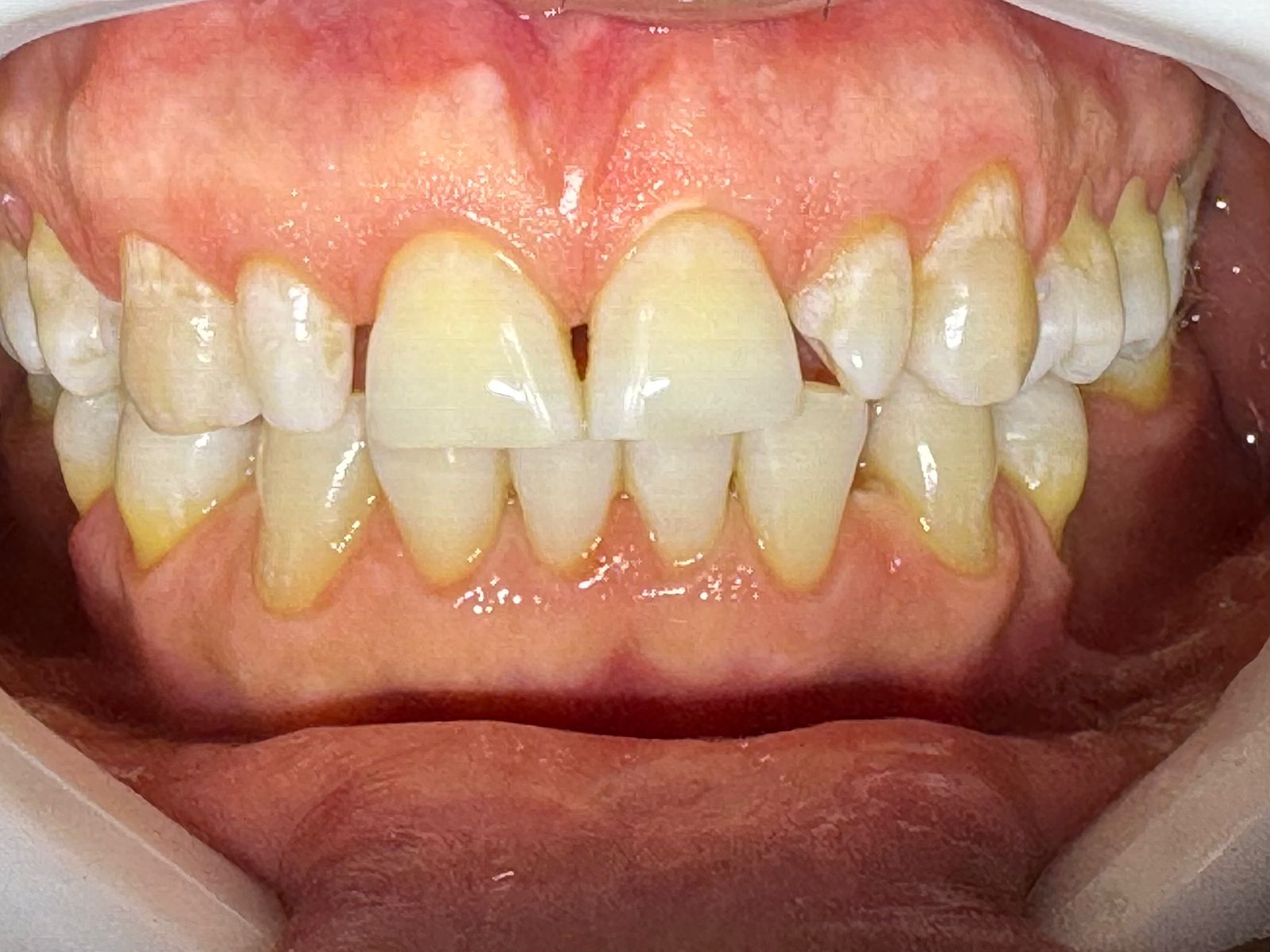 Sorriso do paciente antes do tratamento
