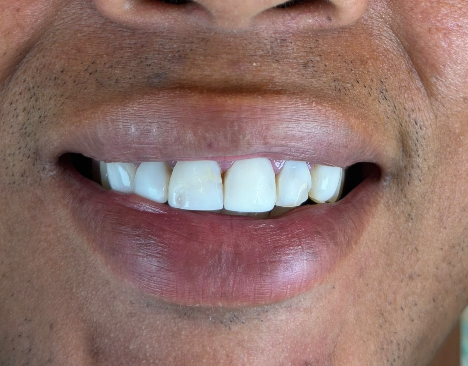 Sorriso do paciente antes do tratamento
