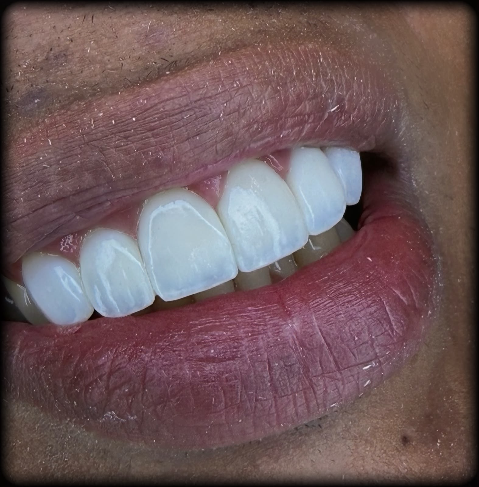 Sorriso do paciente depois do tratamento